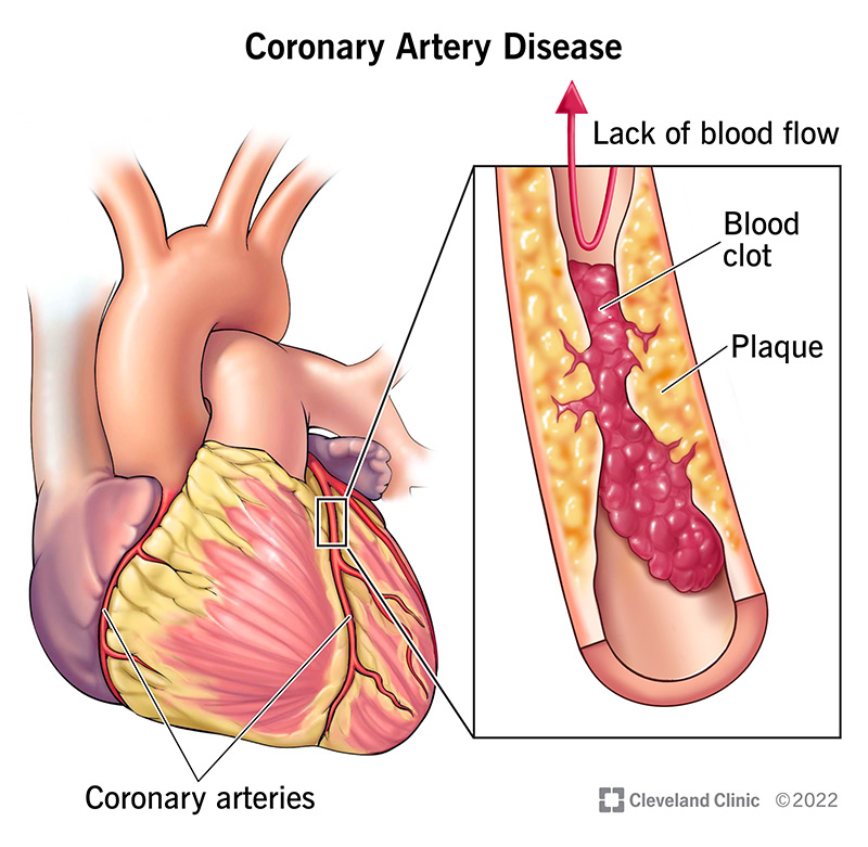 What is Coronary Artery Disease ?
