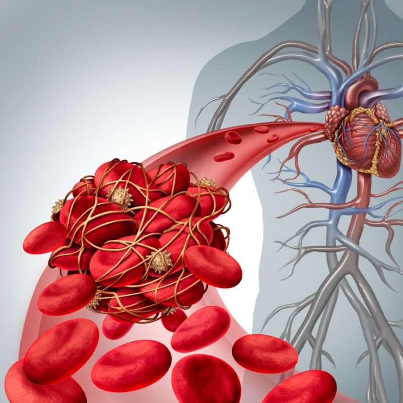 What causes a blood clot in Coronary Heart Disease?
