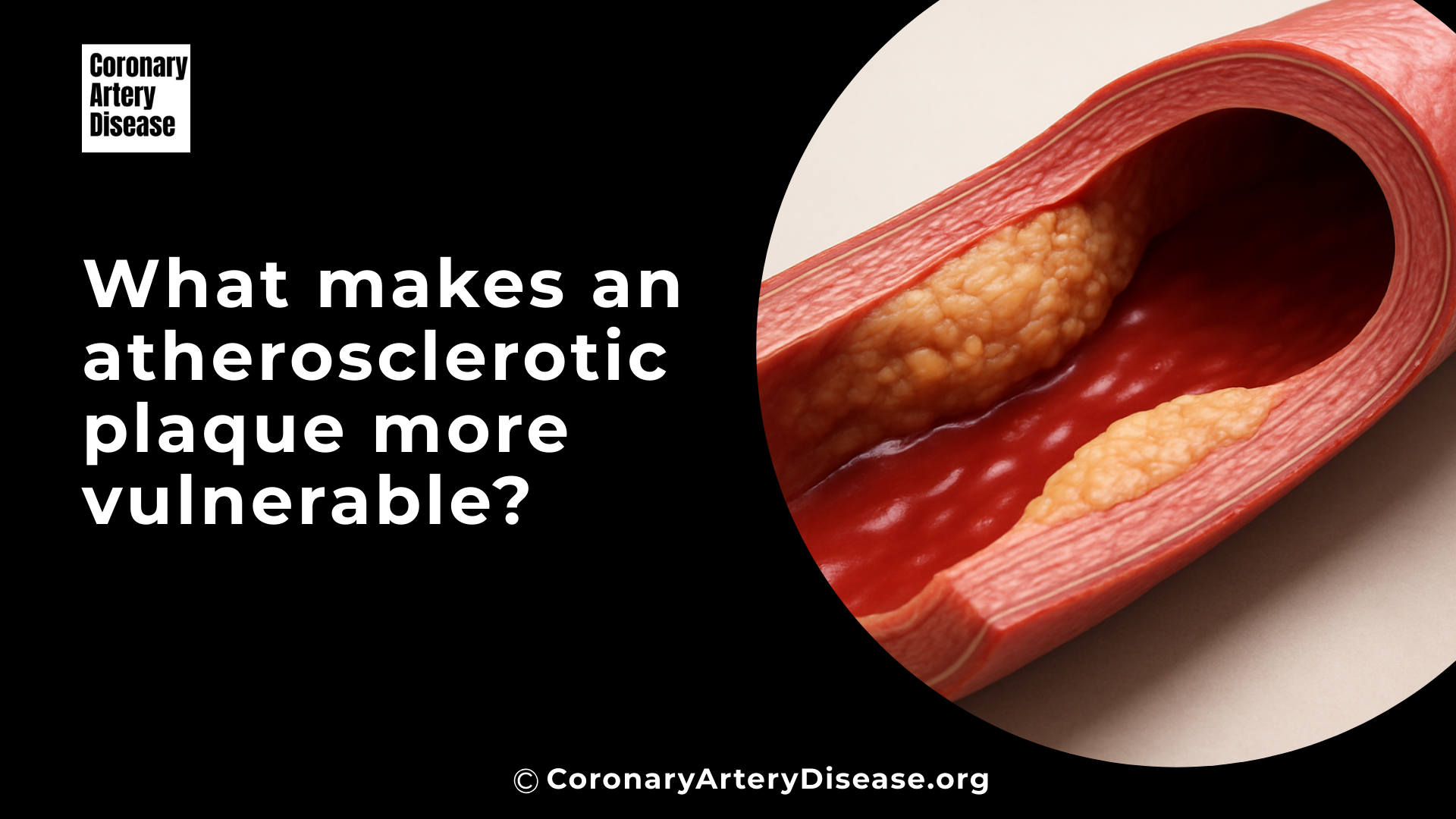 atherosclerosis image