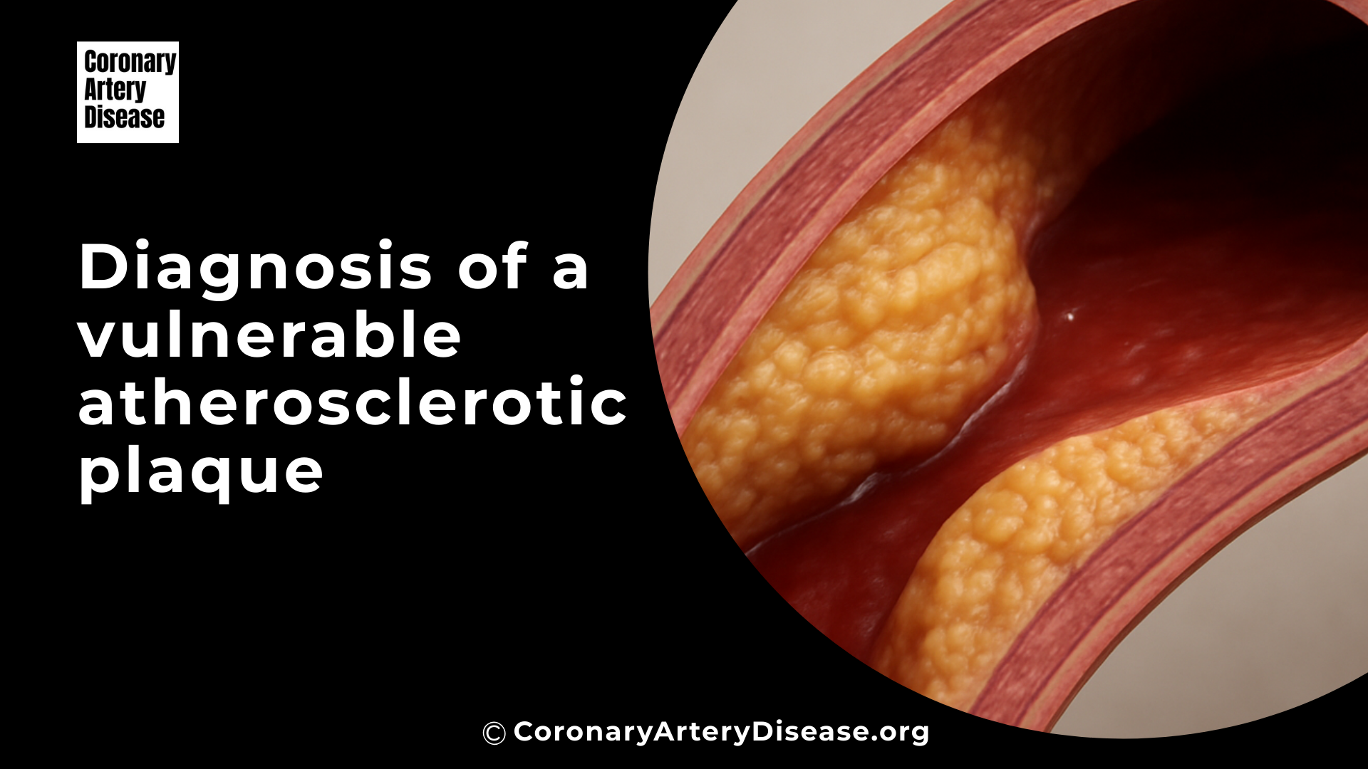 vulnerable atherosclerotic plaque image