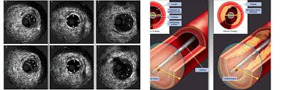 Intravascular Ultrasound (IVUS) device image